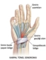 El Bileğinde Sinir Sıkışması Belirtileri ve Tedavisi El Bileğinde Sinir Sıkışması Belirtileri ve Tedavisi