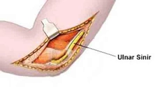 Ulnar Sinir Sıkışması Tedavisi Ulnar Sinir Sıkışması Tedavisi