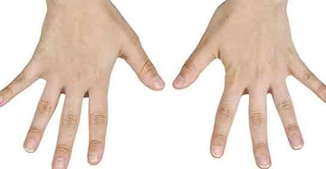 Ellerde Sinir Sıkışması Belirtileri ve Tedavisi