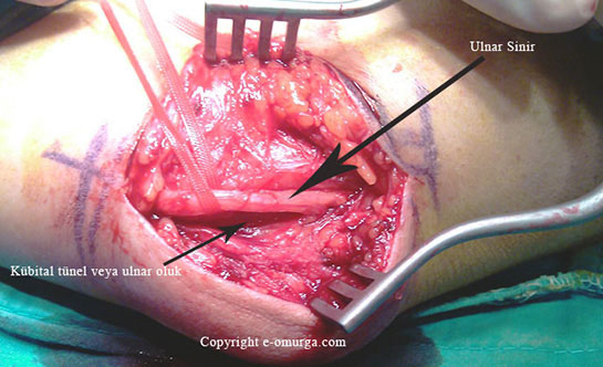 Sol Kolda Sinir Sıkışması Belirtileri ve Tedavisi